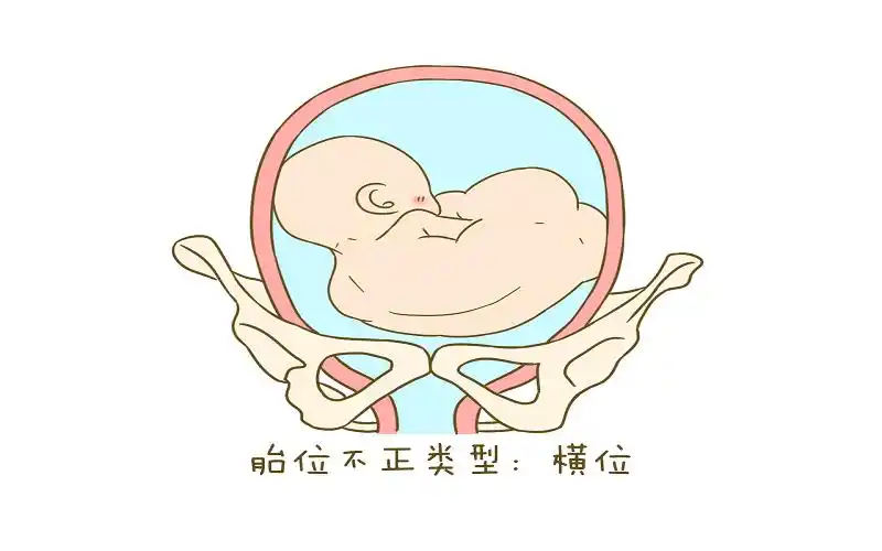 胎儿横位都是生女孩并不可靠生男孩几率仍然高