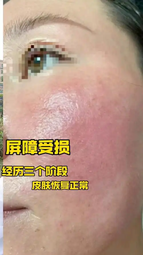 屏障受损,经历三个阶段,皮肤恢复正常