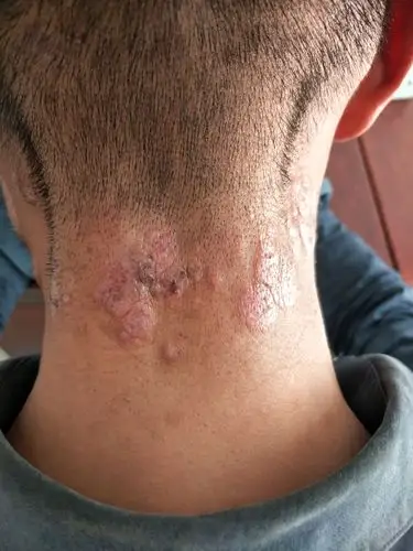 慢性日光性皮炎(慢光化)