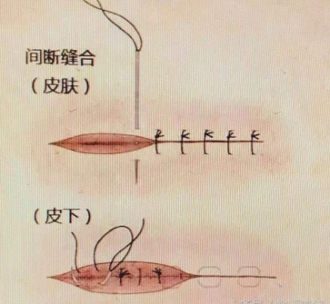 小线头,大反应 关于线头反应你应该知道的那些事