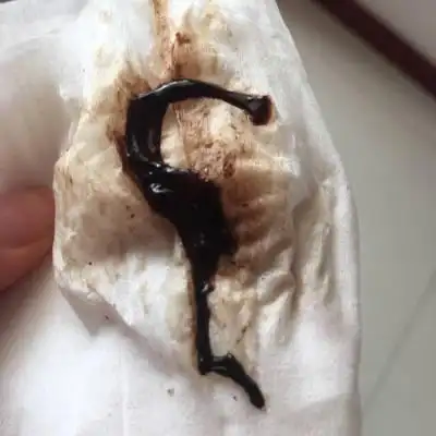 孕四十几天上周就有褐色分泌物,昨天情绪激动了点今早发现有黑色的