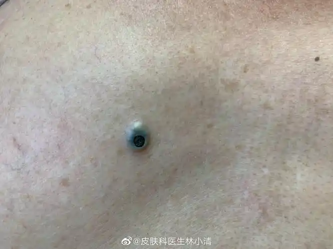 这个不是大的黑头粉刺,也不是皮脂腺囊肿.