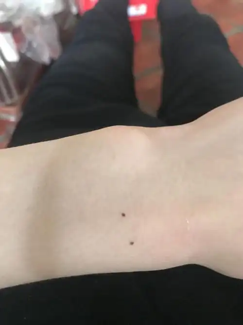 请问手腕这2个痣有什么说法