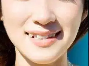 长相不好的虎牙一拔了之可以吗