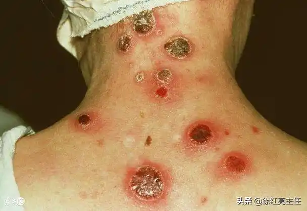 检查结果梅毒1:8吓傻全家