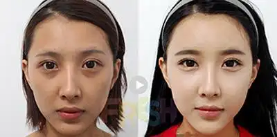 韩国芙莱思整形医院面部脂肪填充手术案例