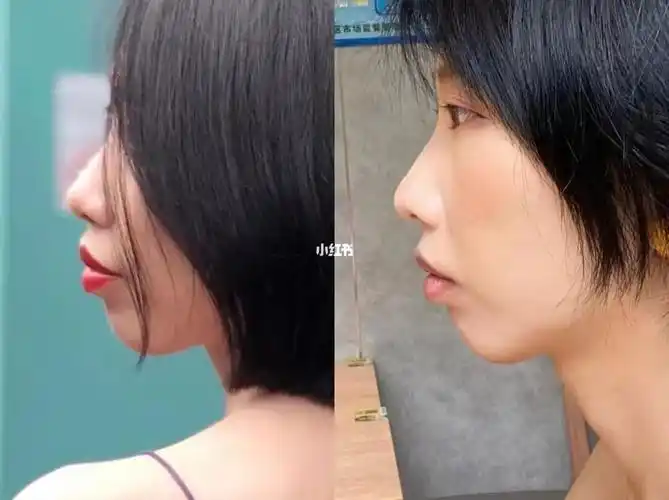 戴牙套第九个月变化好大越来越爱露齿笑了