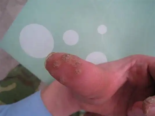 肉瘊子图片 (12)