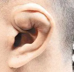 什么是耳廓假性囊肿?