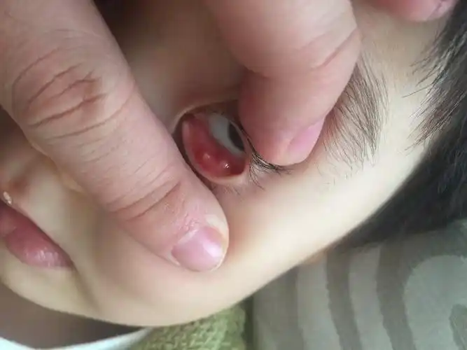 孩子两个月以前发现张了撒粒肿在左眼下眼睑里面长了两个一个