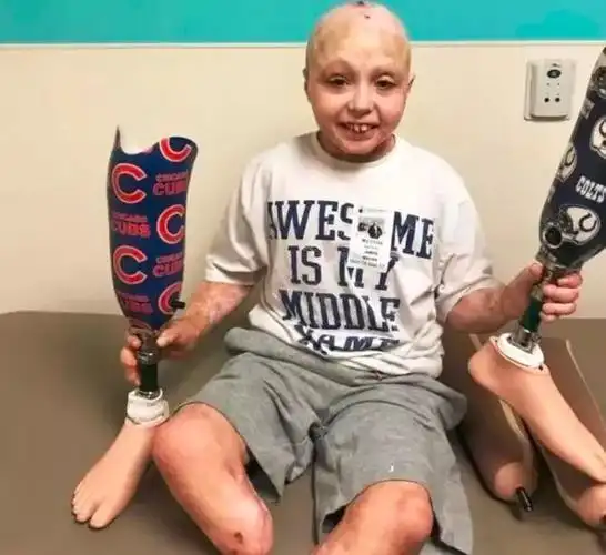 10岁小男孩同意截肢,大功臣竟是这只没腿的金毛!