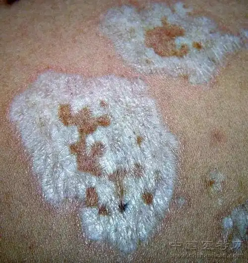 史上最全的皮肤病图谱来了(修订版)!