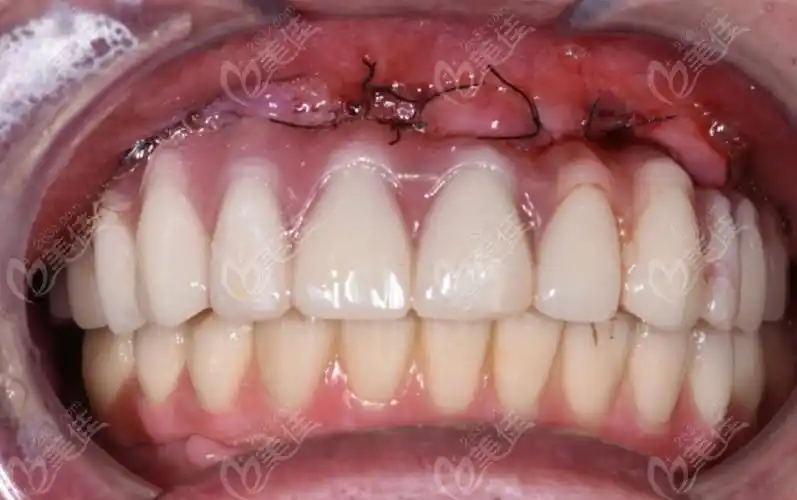 上半口种植牙图片