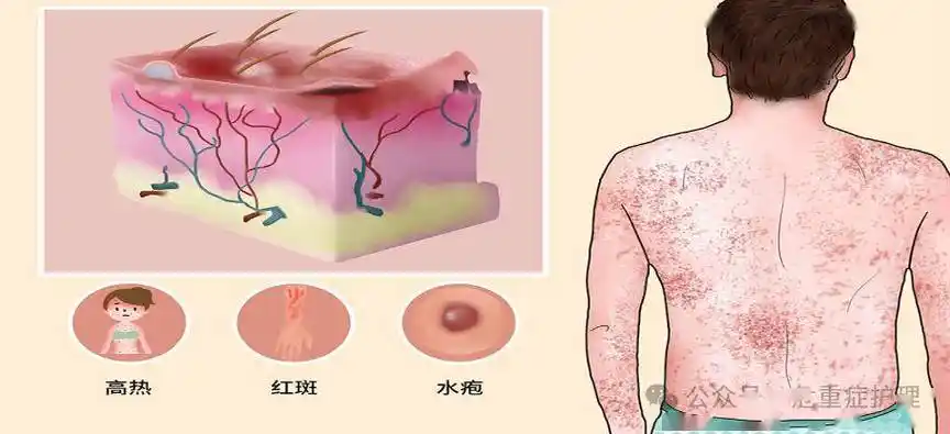 一例中毒性表皮坏死松解症患者护理分享_治疗_药物_皮肤