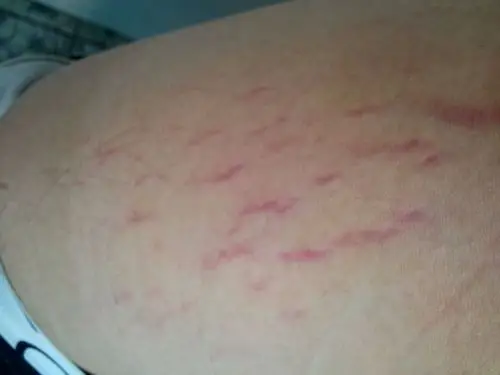 大腿根有一条条的红色痕迹