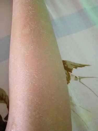 不知怎么的,腿上起干皮了.也不知道是不是鱼鳞病.