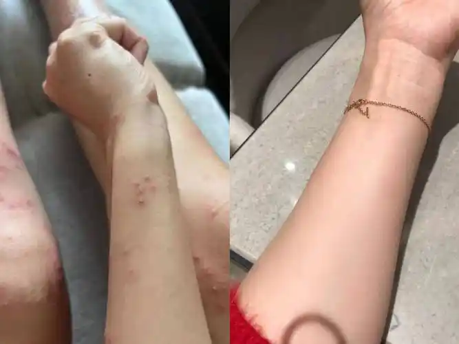 皮肤还是长红疹瘙痒,试试这三个方法,30天恢复好皮肤_严重_关键_药膏