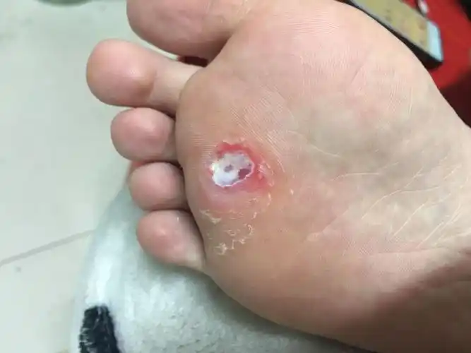 鸡眼,这算拔干净了吗?