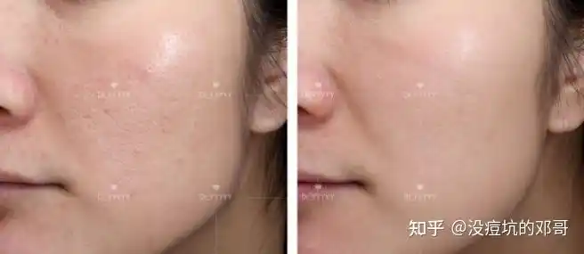 如何用医美手段收缩可以插秧的毛孔最全指南篇