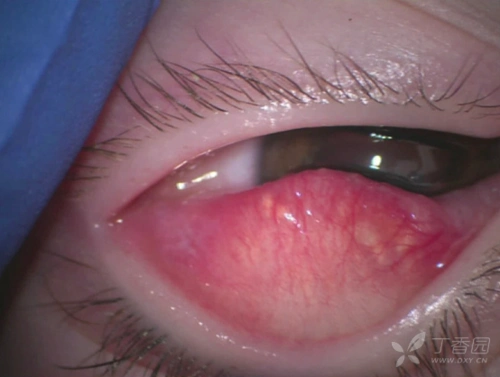 儿童时期睑角结膜炎(bkc)