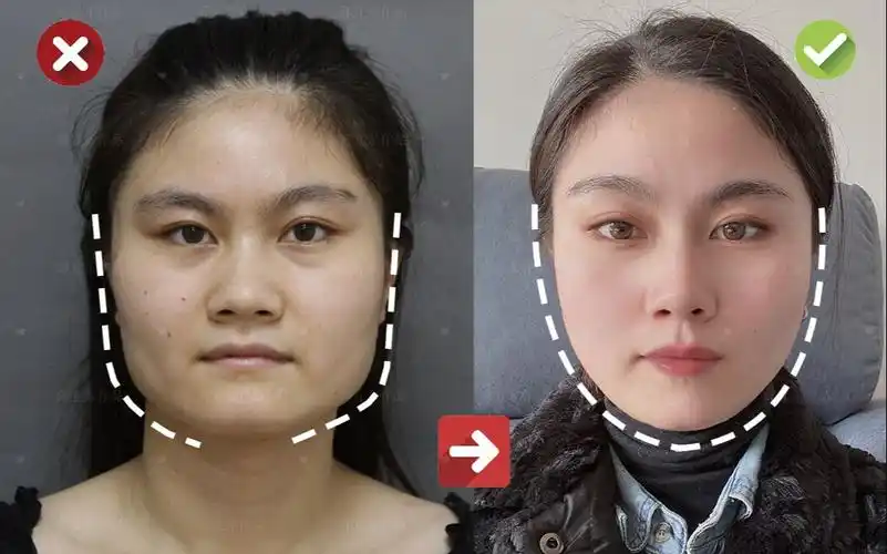 改脸型医生邱立东:方脸变小脸,下颌角 祛外板3个月,换脸了?