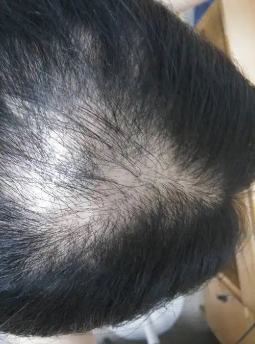 头发都掉成这样了,去医院检查啥毛病没有,怎么办啊?急死人了