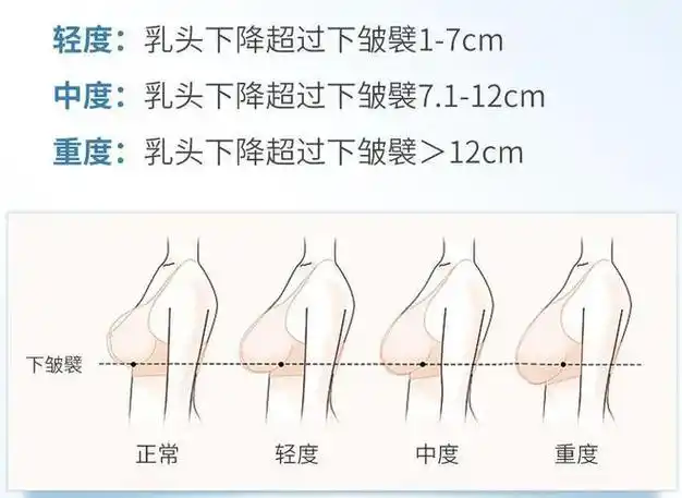 辽宁杏林整形科普胸部整形就是隆胸变大