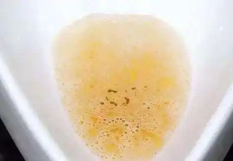 尽快查一下尿酸,肾脏或许已经不保1,尿液颜色变深通常我们尿酸的颜色