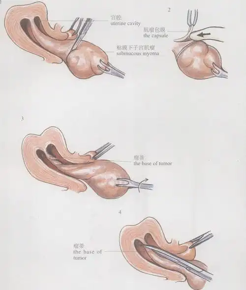 (图) 粘膜下子宫肌瘤摘除术