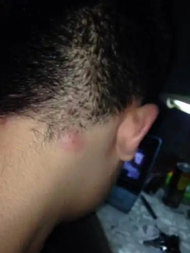 请问我这个是毛囊炎还是淋巴结肿大啊?