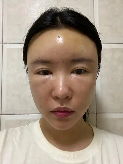 【自体脂肪填充】第三天.