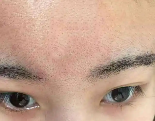 1,单纯性毛孔粗大知己知彼百战不殆,以下除了介绍毛孔形态和形成原因