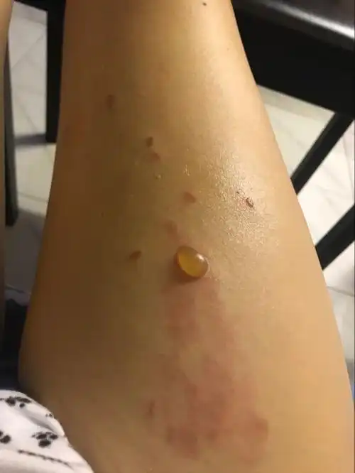 大腿被白粥烫到会不会留疤痕 起了一个泡