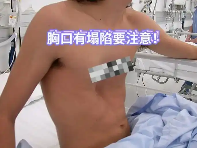 小时候以为胸口有凹陷是比较瘦!