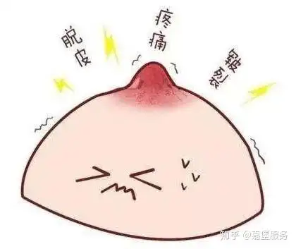 乳头继续红肿,哺乳时有剧烈疼痛,结痂亦可浸软,擦损