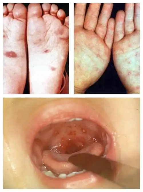 可防可控的"手足口",我们一起行动!