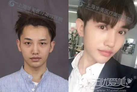 在上海华美做了双眼皮手术前后对比