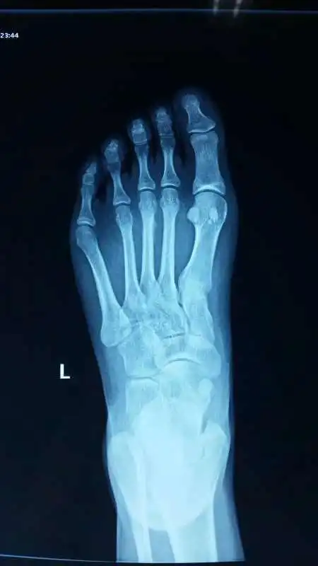 我百度了正常的舟骨,没有多一块骨头,照片网上找的