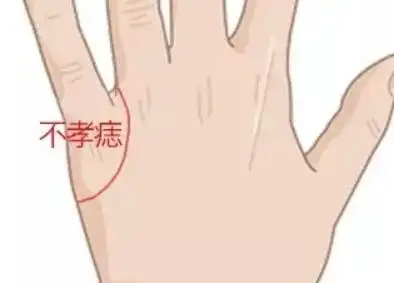 厄运痣手背上的食指,中指,无名指,小指四个指关节下不是好痣.