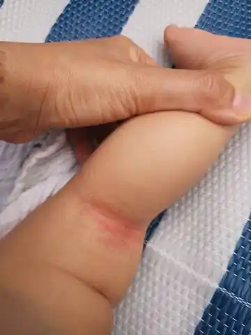 快4个月的宝宝～身体皮肤褶皱地方有～我们这里温度23-25度左右～如何