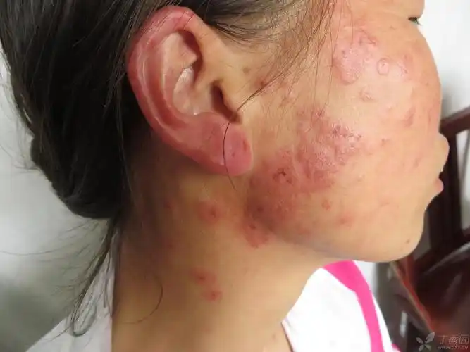 【共享】一例典型的多形性日光疹 - 皮肤与性传播疾病讨论版 -丁香园