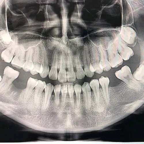 种植牙真的不是老年人的专利~我来种牙了~一颗大牙蛀_圈子-新氧美容