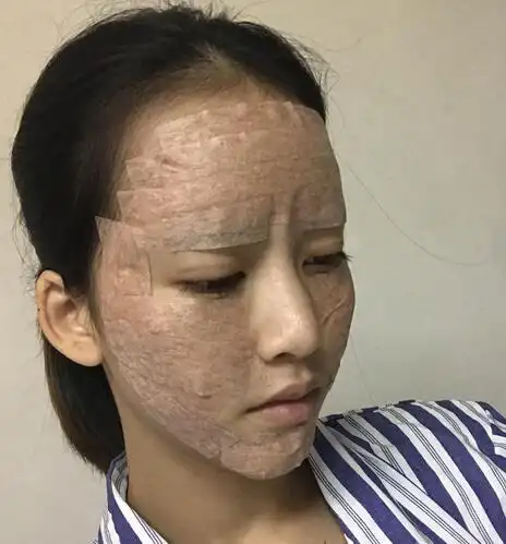 脂肪填充对于额头太阳穴泪沟苹果肌面颊等部位有很好的填充塑形作用