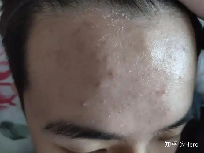 头皮这是什么情况啊干燥起皮摸起来硬硬的