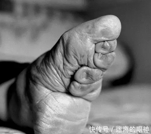 揭开三寸金莲血泪史!用x光看惊悚到像是p出来!