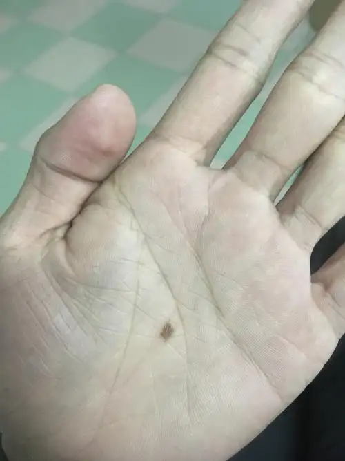 女人左手掌心有两颗痣(女人左手掌心有两颗痣好吗)