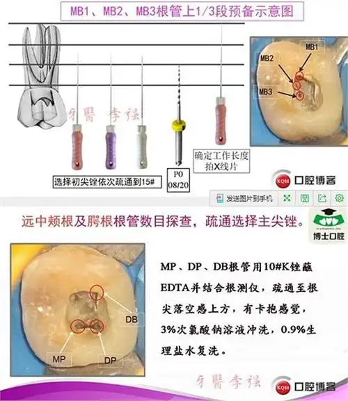 罕见上颌第一恒磨牙6根管的病例报告暨plex锉的根管治疗之路济南博士