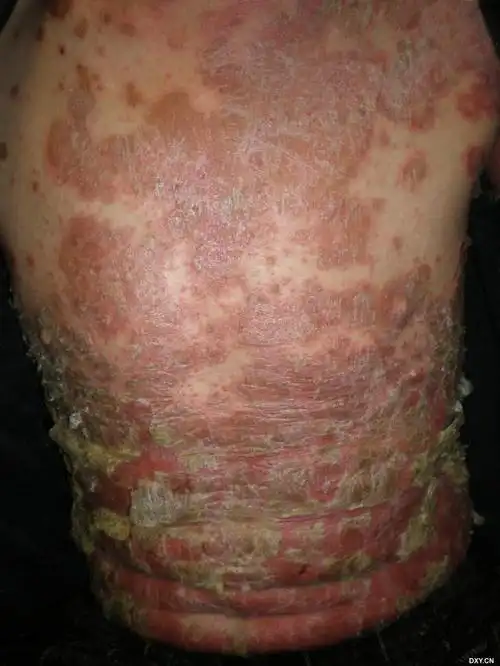 【共享】有关艾滋病的皮肤表现