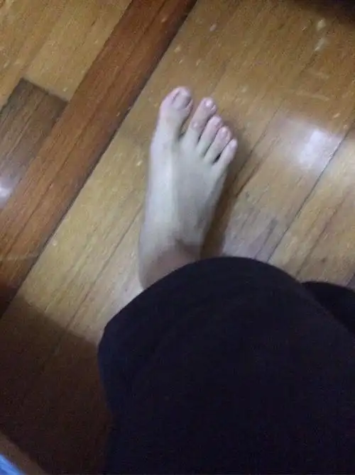 脚的足舟骨突出怎么办