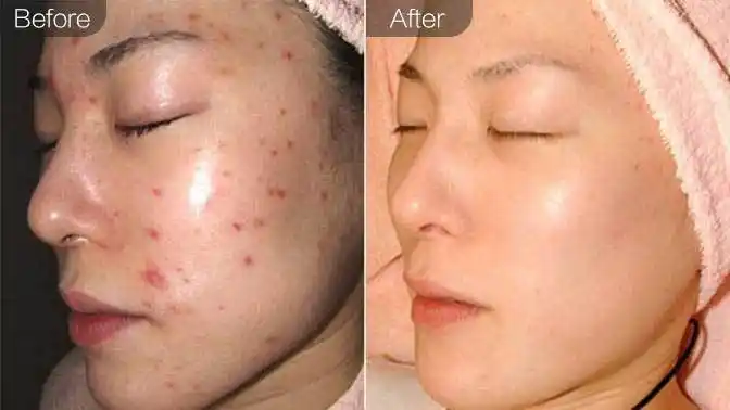 果酸&杏仁酸焕肤